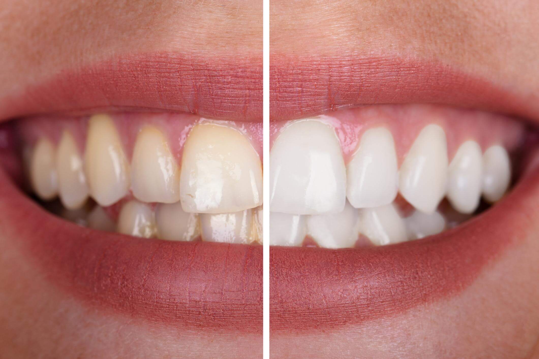 Wybielanie zębów systemem ZOOM - przed i po