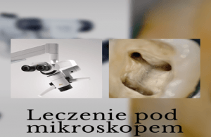 leczenie kanałowe pod mikroskopem